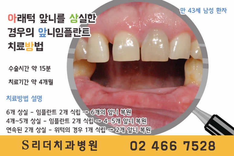 앞니임플란트 몇개를 심어야할까? 관련 이미지 4