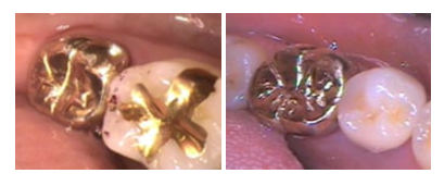 Gwangjin-gu Dental Clinic: Missing the Timing for Cavity Treatment Can Be Serious | Check the Changes by Stage image 6