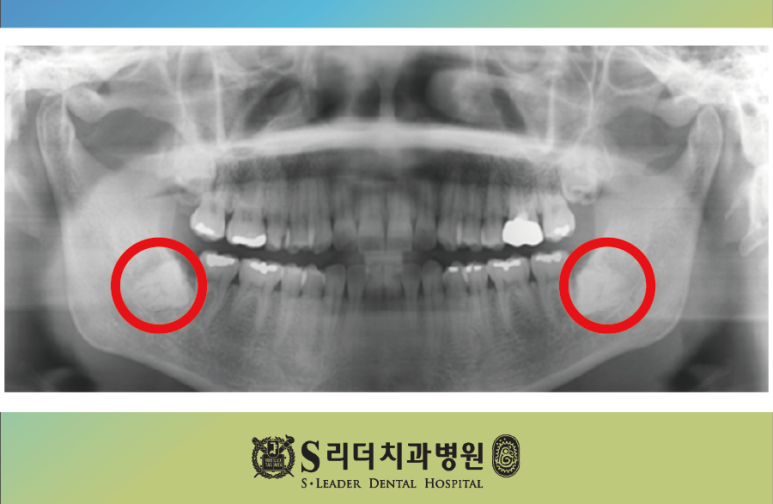 Seongsu-dong Dental Clinic: Why Wisdom Tooth Inflammation Happens and Why Care for Surrounding Teeth Matters image 5