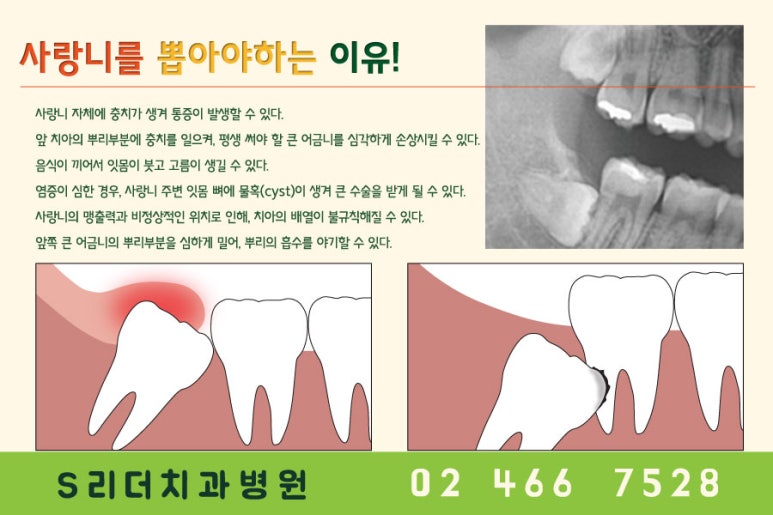 건대치과 사랑니는 왜 나올까? 관련 이미지 3