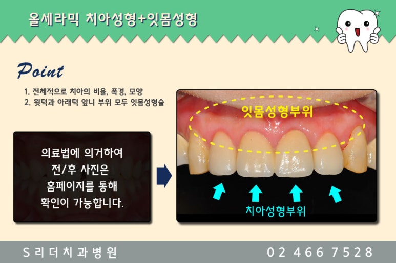광진구치과 치아성형으로 컴플렉스 극뽁~ 관련 이미지 5