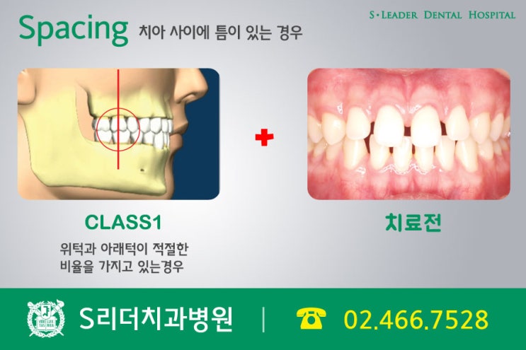 군자동치과에서 치아교정 주인공은 나야나 관련 이미지 4