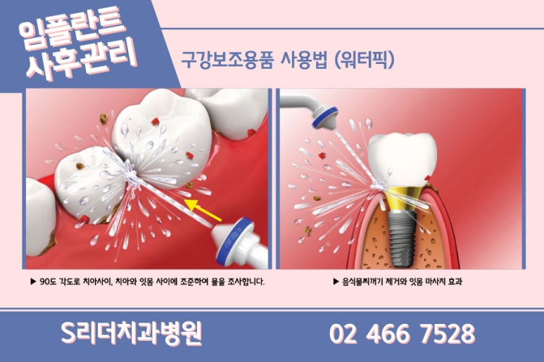 광진구치과 임플란트 단점정리 관련 이미지 20