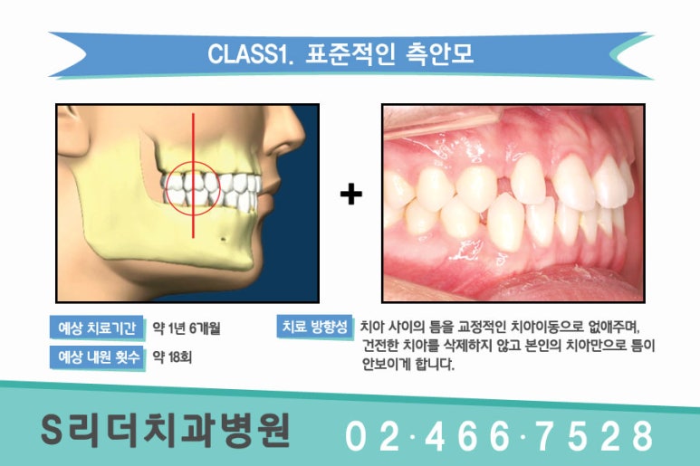 건대교정치과 듬성듬성 벌어진 치아가 고민이라면.. 관련 이미지 3