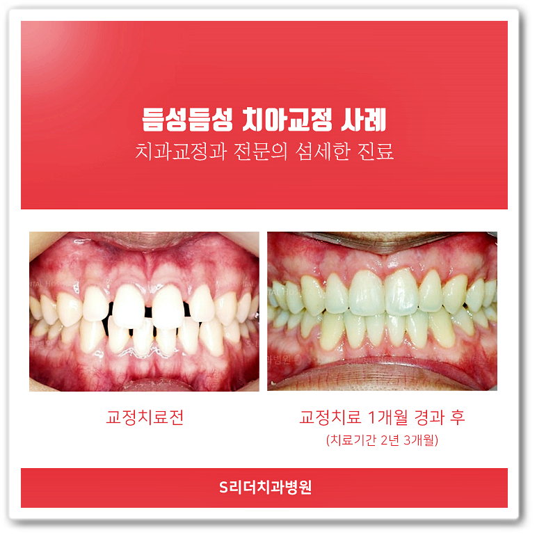 건대치과(7인의 협동진료, 양심적 성공적)건대교정치과 세밀한진료를 진행합니다! 관련 이미지 5