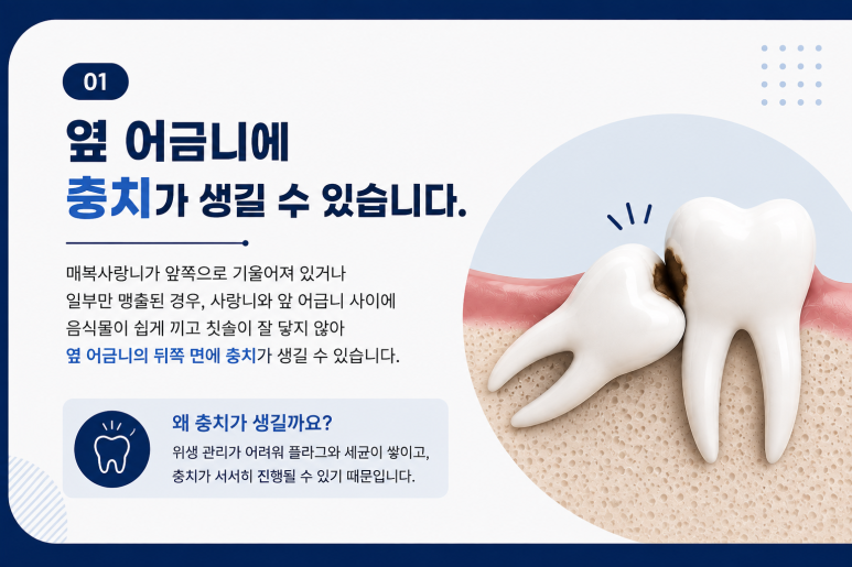 건대입구치과, 매복 사랑니가 옆 치아에 영향을 줄 수도 있을까요? 관련 이미지 4