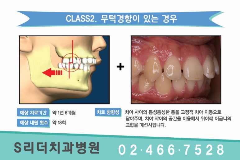 건대교정치과 듬성듬성 벌어진 치아가 고민이라면.. 관련 이미지 4