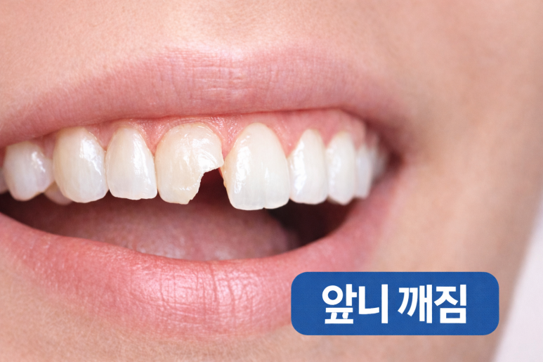 Guwi Station Dental Clinic｜Front Tooth Fracture Treatment Criteria: Resin vs. Laminate vs. Crown image 2