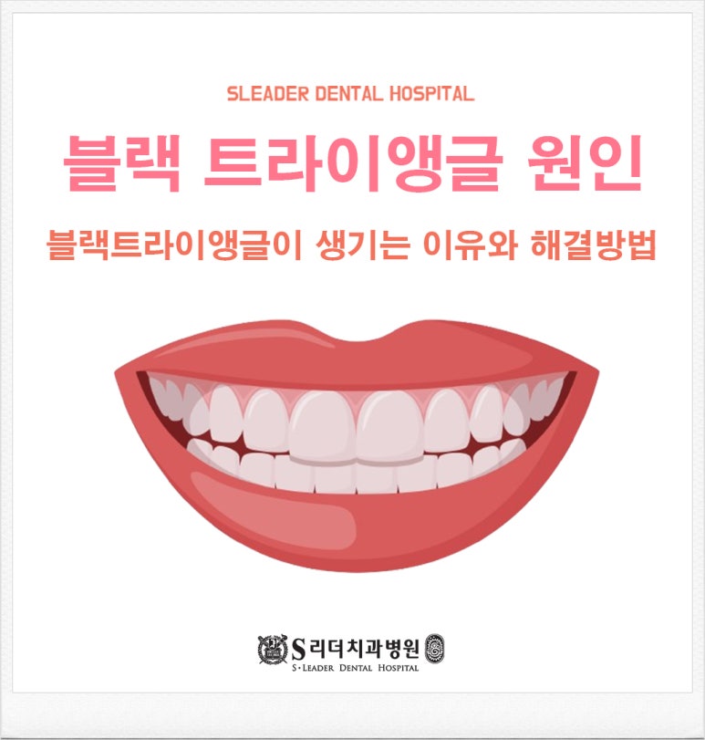 군자역치과, 블랙 트라이앵글이 생기는 이유와 해결 방법 관련 이미지 1