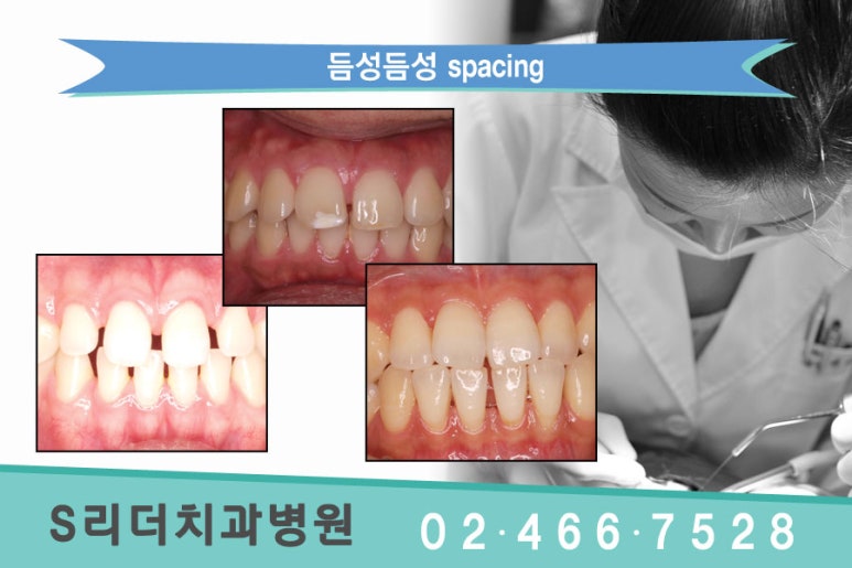 건대교정치과 듬성듬성 벌어진 치아가 고민이라면.. 관련 이미지 2