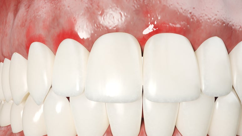 [Achasan Station Orthodontics] How to Correct Bunny Teeth While Addressing Both Aesthetics and Function image 3