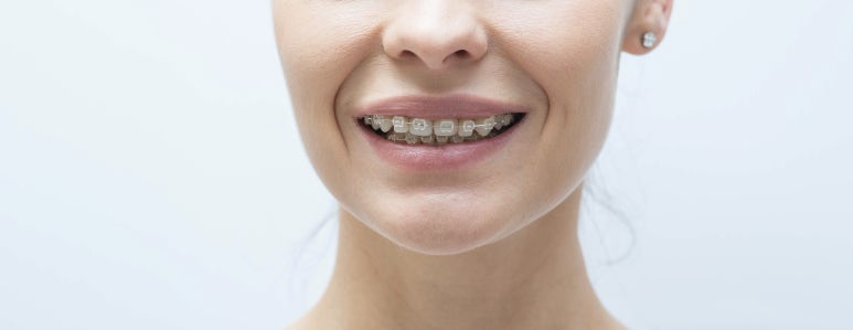 Seoul Dental Clinic Recommendation: If Your Orthodontics Shifted Again... Do You Really Need Retreatment? image 6