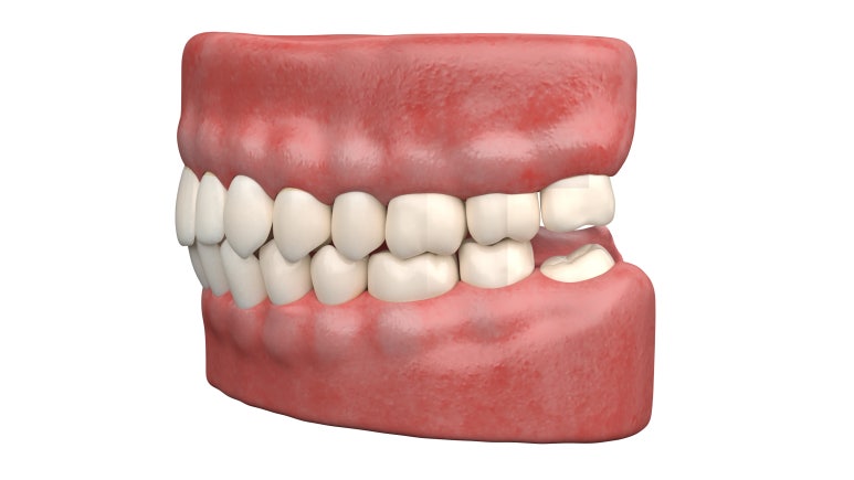 Gwangjin-gu Dental Clinic: Do I Really Need to Remove My Wisdom Teeth Before Orthodontic Treatment? image 5