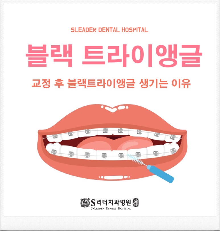 Sungsu-dong Dental Clinic, Why Does the ‘Black Triangle’ That Looks Like Loose Stitches Appear After Orthodontic Treatment? image 1