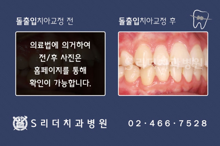 광진구~성동구치아교정치과, 치아교정중에 충치가생긴다고? 관련 이미지 6