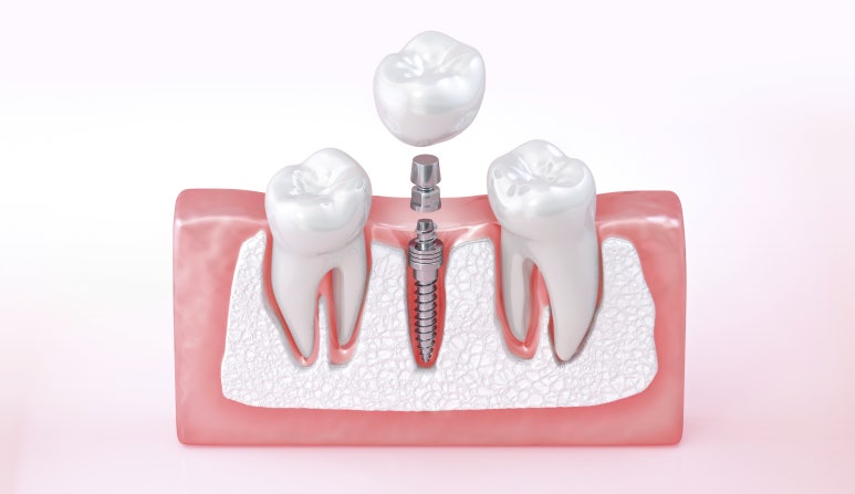 Seongdong-gu Dental Clinic: What Should Be Considered for Front Tooth Implants? image 3
