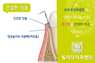 건대입구치과 | 잇몸병은 왜 조용히 진행될까? 초기 신호 체크리스트 10가지 관련 이미지 5