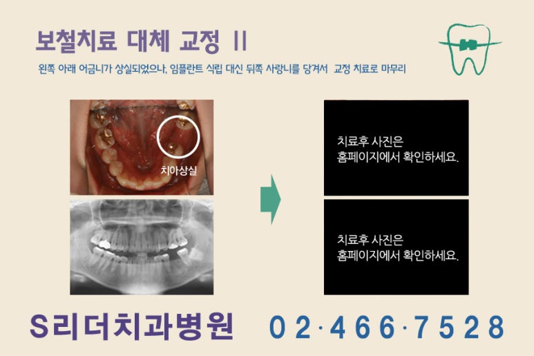 건대치아교정 사랑니로 교정까지.. 관련 이미지 3