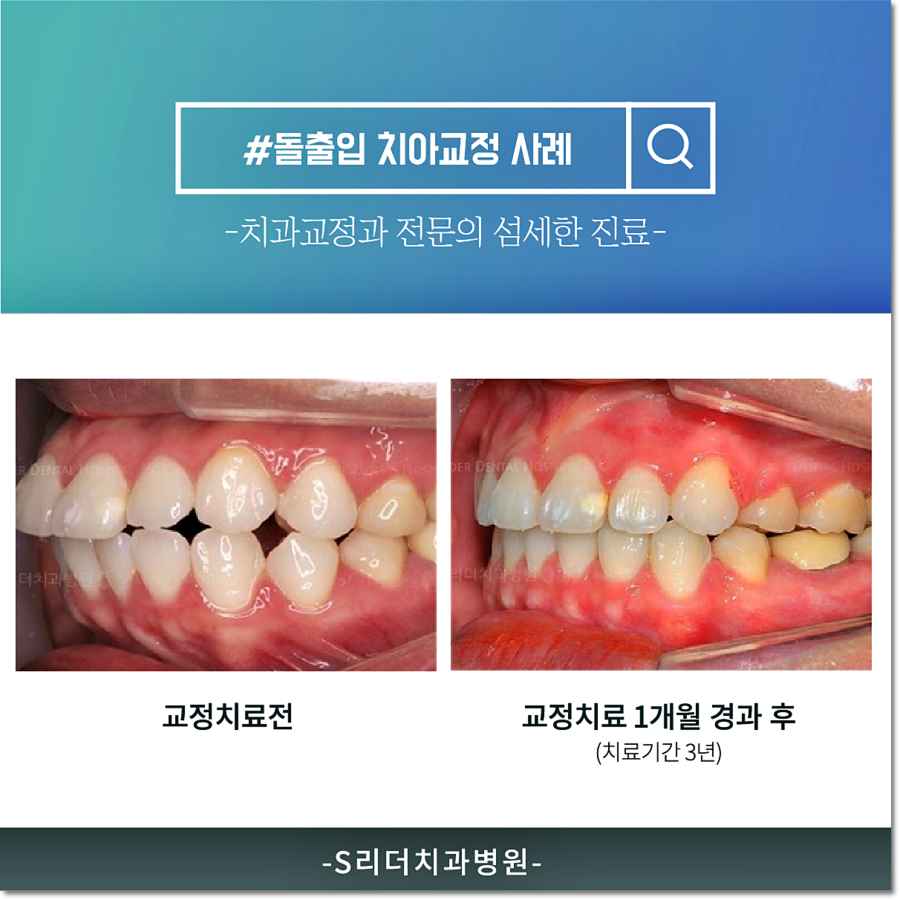건대교정 치과, 과잉진료없는 투명한 건대치과 관련 이미지 6