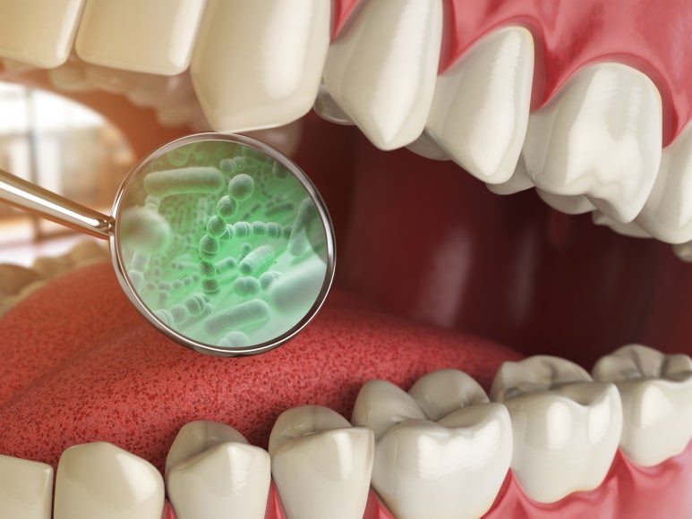 5 Dental Causes of Halitosis (Bad Breath) Explained by Sagajeong Station Dental Clinic image 4
