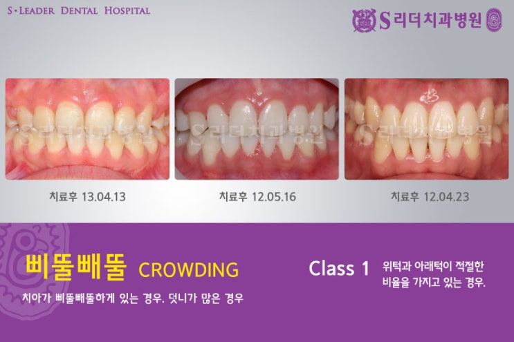 건대교정치과 내 마음에 쏙 드는 교정치과 어때요? 관련 이미지 7