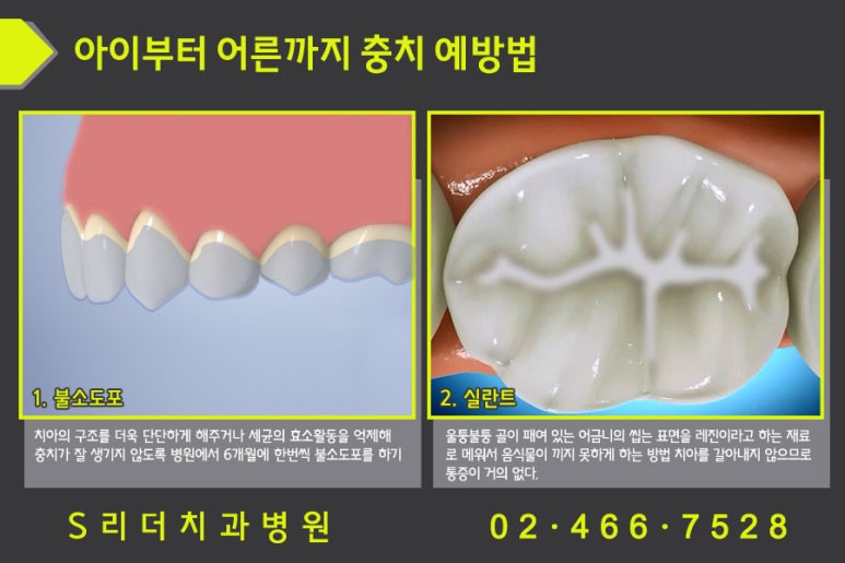 충치(치아우식증)예방 자양동치과,화양동치과 관련 이미지 6