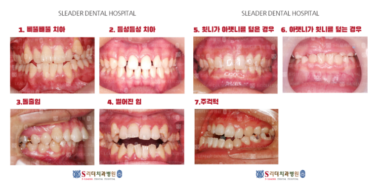 서울치아교정잘하는곳 어린이부정교합 교정시기가 궁금하다면 관련 이미지 1
