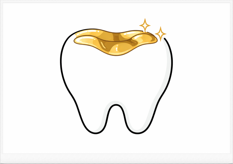 Seoul Dental Clinic Recommendation｜Complete Guide to Cavity Treatment Methods – Criteria for Choosing Resin, Inlay, and Crown image 5