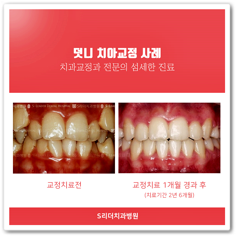 건대치과(7인의 협동진료, 양심적 성공적)건대교정치과 세밀한진료를 진행합니다! 관련 이미지 7
