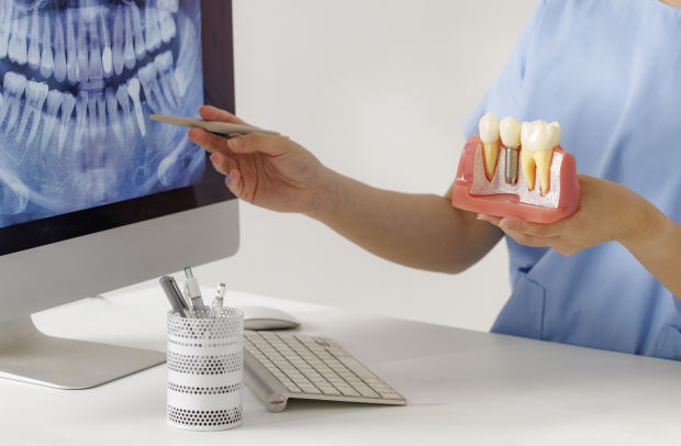 3 Things to Check When Considering Implants at Sagajeong Dental Clinic image 4