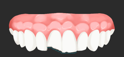 Chipped Front Tooth Treatment: Can It Be Done the Same Day? | A Quick Look at the Process and Timeline at a Gwangui-dong Dental Clinic image 3