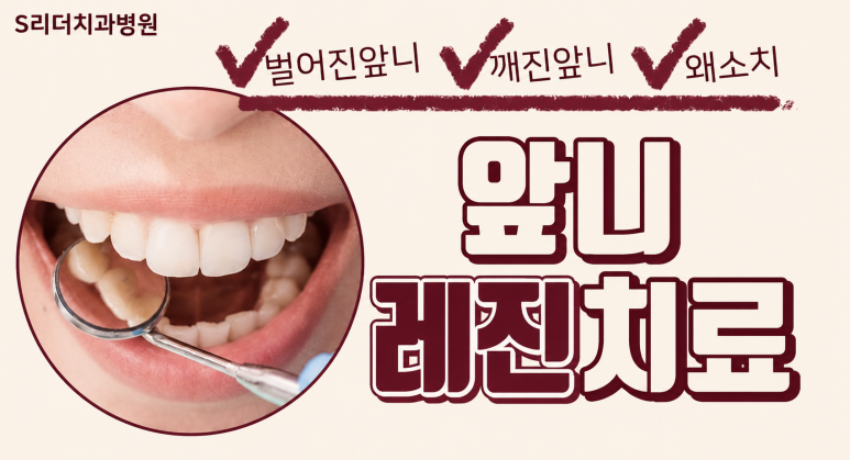 송정동치과, 앞니 레진은 얼마나 오래 사용할 수 있을까요? 관련 이미지 2