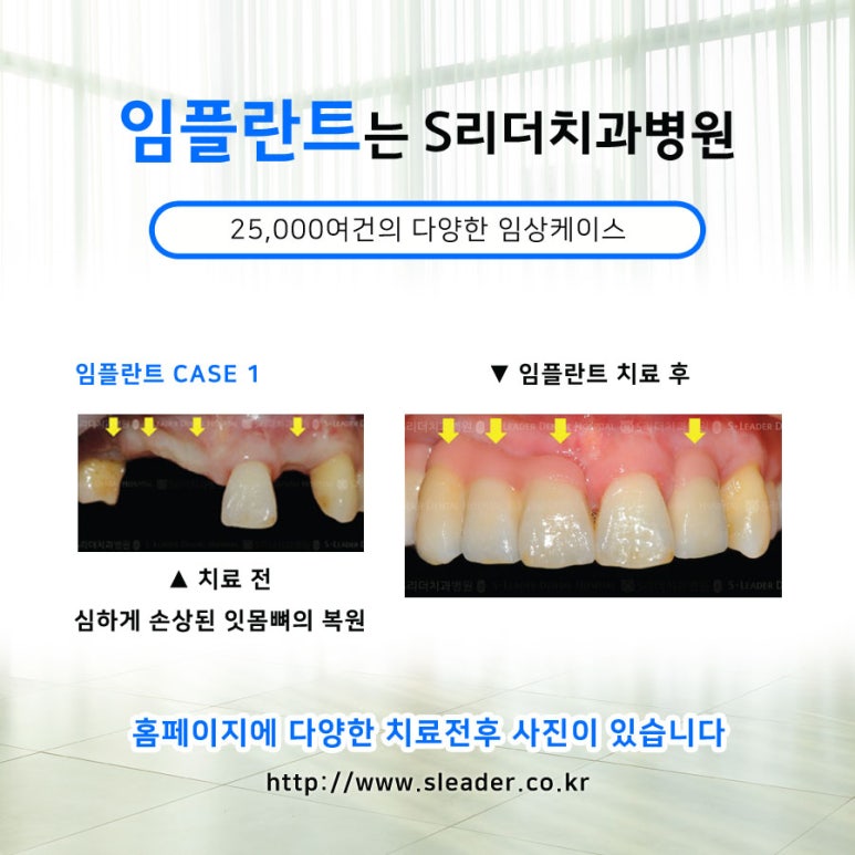 [Jayang Station Implant] Full-Mouth Implants, Including Systematic Aftercare image 5
