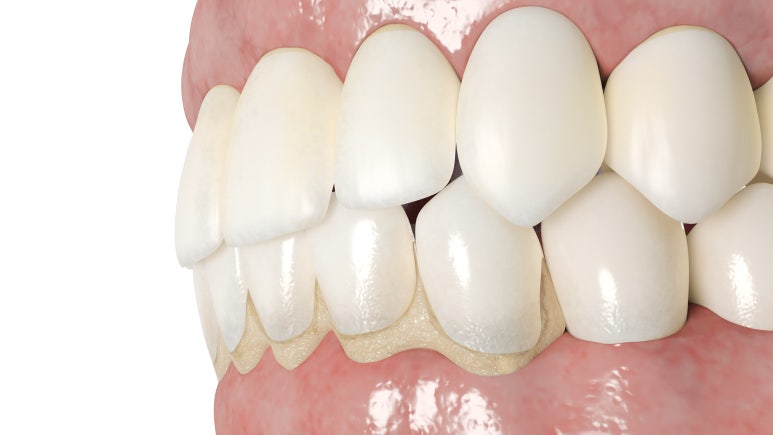 Sungsu-dong Dental Clinic, Why Does the ‘Black Triangle’ That Looks Like Loose Stitches Appear After Orthodontic Treatment? image 3