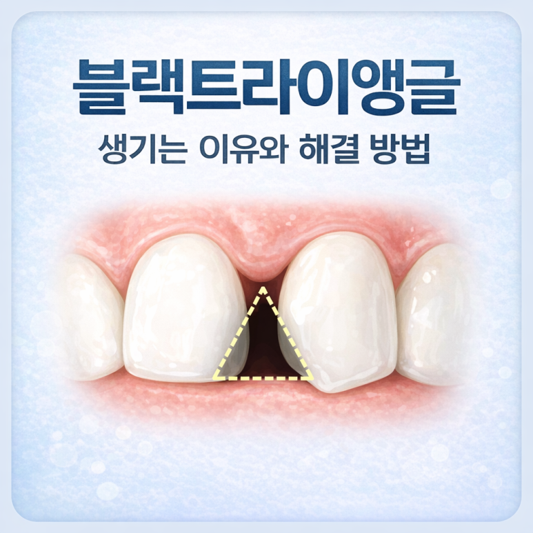 Seoul Yangsim Dental Clinic｜Why Black Triangles Form and How to Fix Them image 1