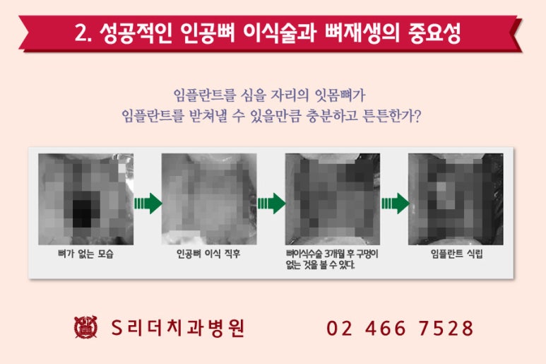 건대치과 성공적인 임플란트를 위한 포인트! 관련 이미지 5