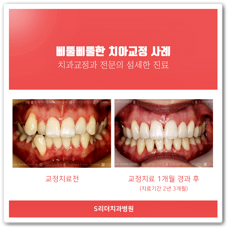 건대치과(7인의 협동진료, 양심적 성공적)건대교정치과 세밀한진료를 진행합니다! 관련 이미지 6