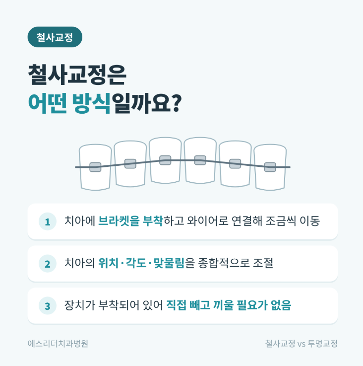 자양동치과, 철사 교정 vs 투명교정, 나에게 맞는 건 뭘까? 관련 이미지 2