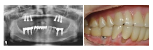 Gwangjin-gu Dental Clinic: Missing the Timing for Cavity Treatment Can Be Serious | Check the Changes by Stage image 7