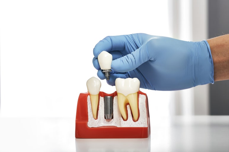[Seoul Implant Dental Clinic] Before implant placement, be sure to check your oral condition first image 4