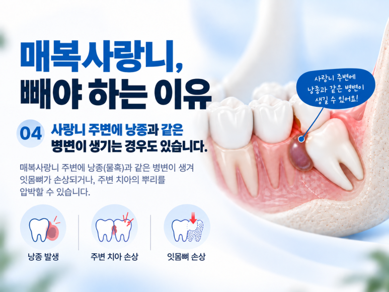 광진구치과병원 매복 사랑니는 왜 발치가 필요할까요? 관련 이미지 6