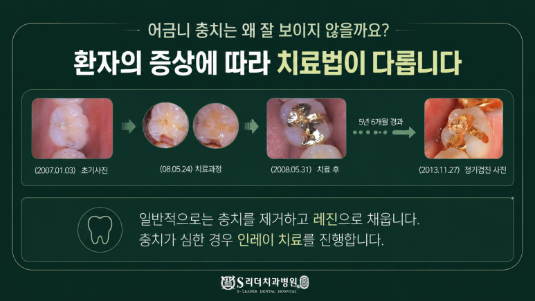 Seoul Famous Dental Clinic: Why It Is Hard to Detect Molars With Cavities Early image 6