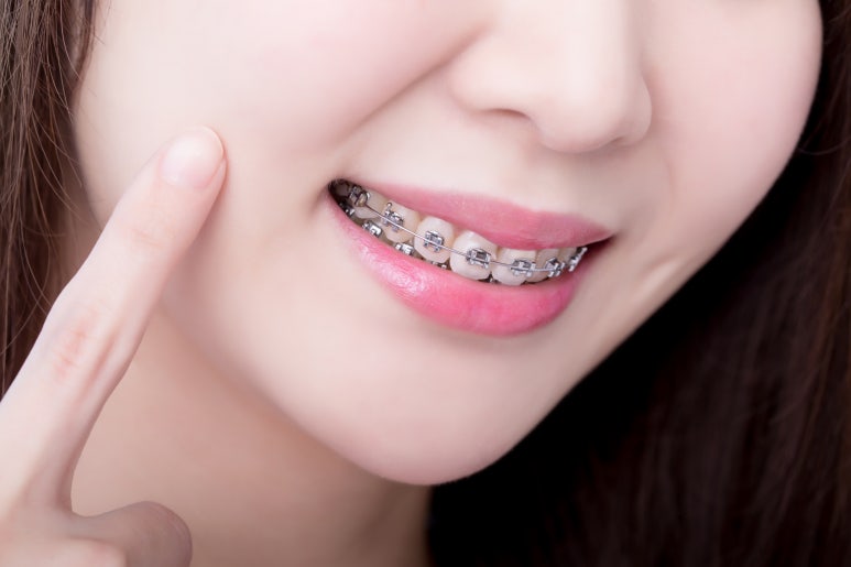 [Recommended Seoul Orthodontic Clinic] If Your Mouth Doesn’t Close Properly and Your Teeth Are Misaligned: Check the Types of Malocclusion image 4