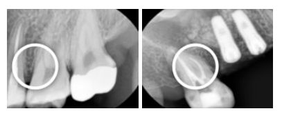 Gwangjin-gu Dental Clinic: Missing the Timing for Cavity Treatment Can Be Serious | Check the Changes by Stage image 5