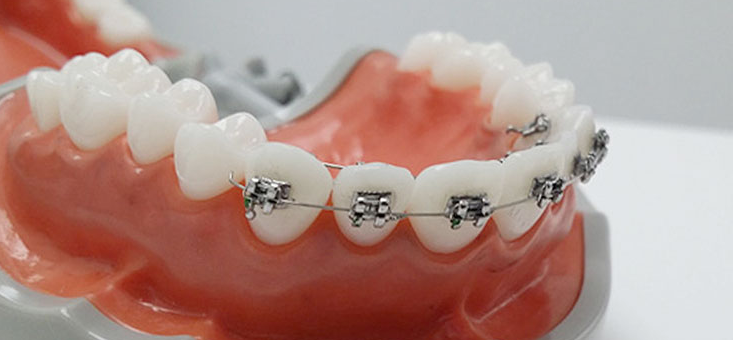 Mangu-dong Dental Clinic: If You Want Partial Orthodontic Treatment for Crooked Teeth Only image 4