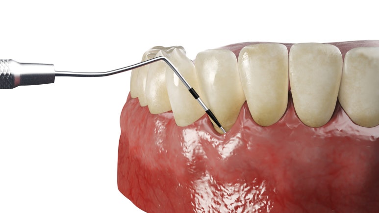 Nungdong Dental Clinic: The Real Reasons Periodontitis Is Progressing Faster in People in Their 20s and 30s, and How to Manage It image 8