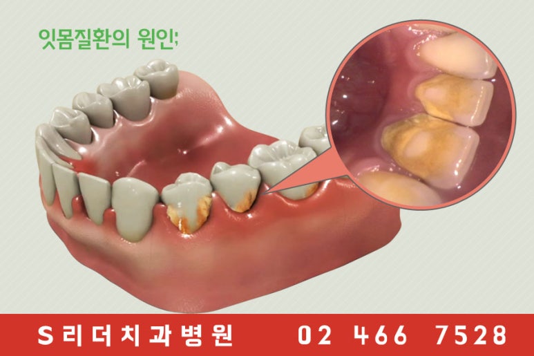 건대치과 잇몸질환 예방할 수 있어요~!! 관련 이미지 3