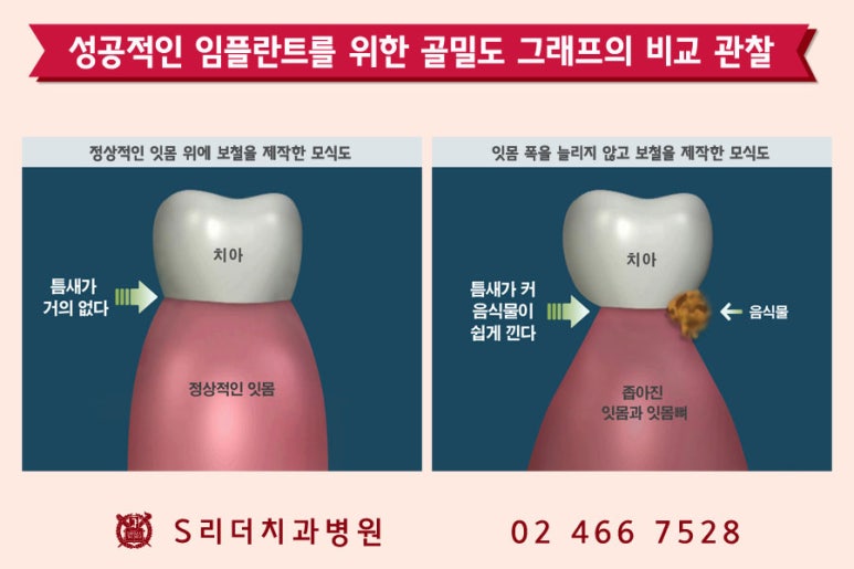 건대치과 성공적인 임플란트를 위한 포인트! 관련 이미지 3