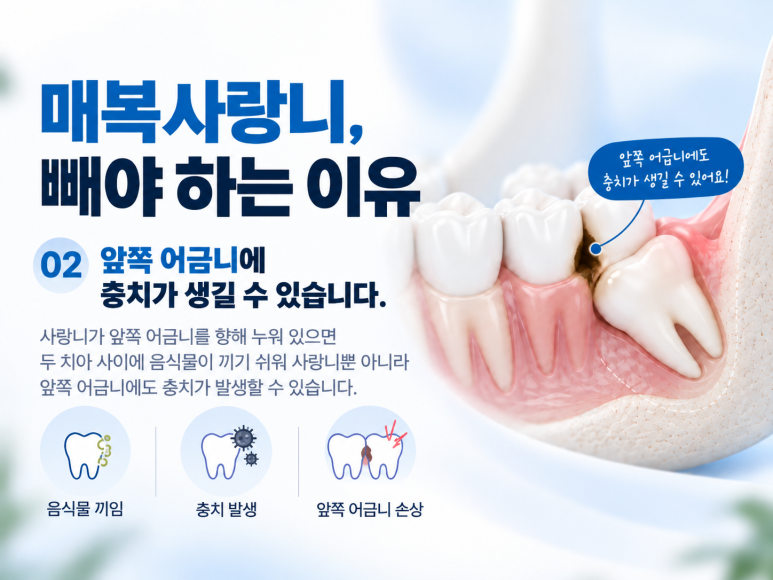 광진구치과병원 매복 사랑니는 왜 발치가 필요할까요? 관련 이미지 4