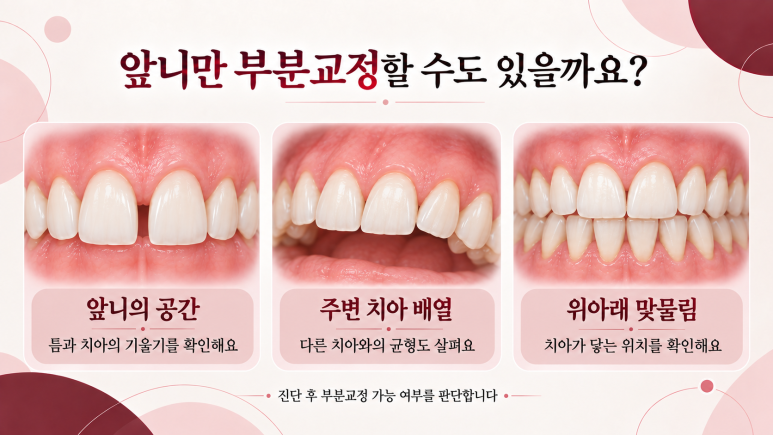 건대역치아교정, 치아 사이가 벌어졌다면 교정으로 해결할 수 있을까요? 관련 이미지 4